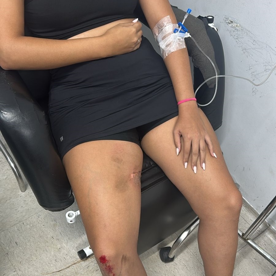 Mulher reage a assalto, cai com moto e sofre queimadura durante roubo em Maringá